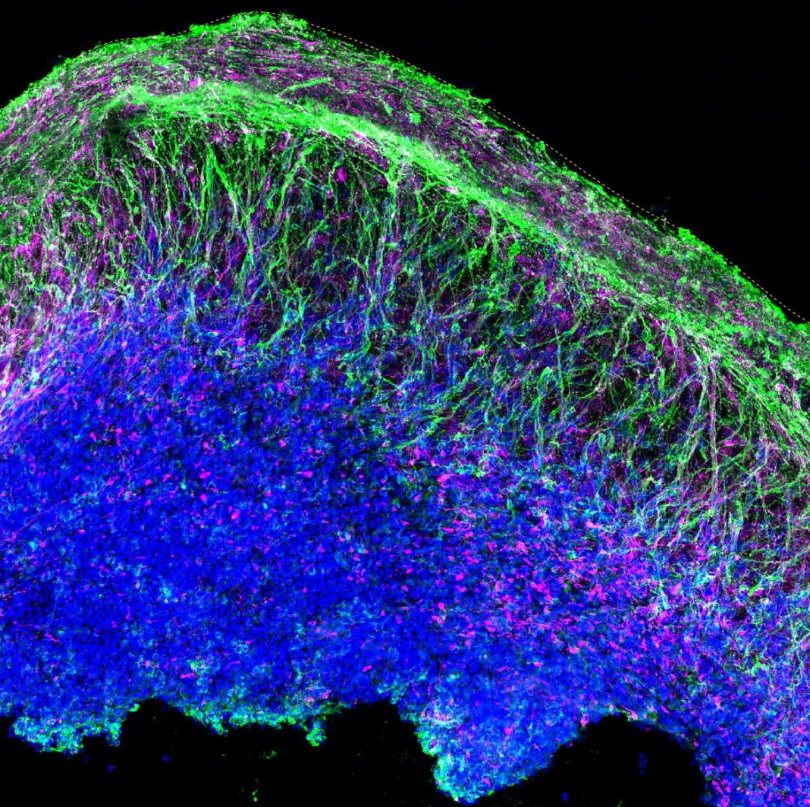 干细胞治疗精神分裂症最新进展！